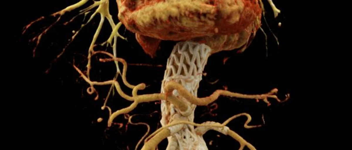 Aortic Scan