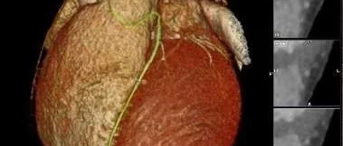 3D image of a heart