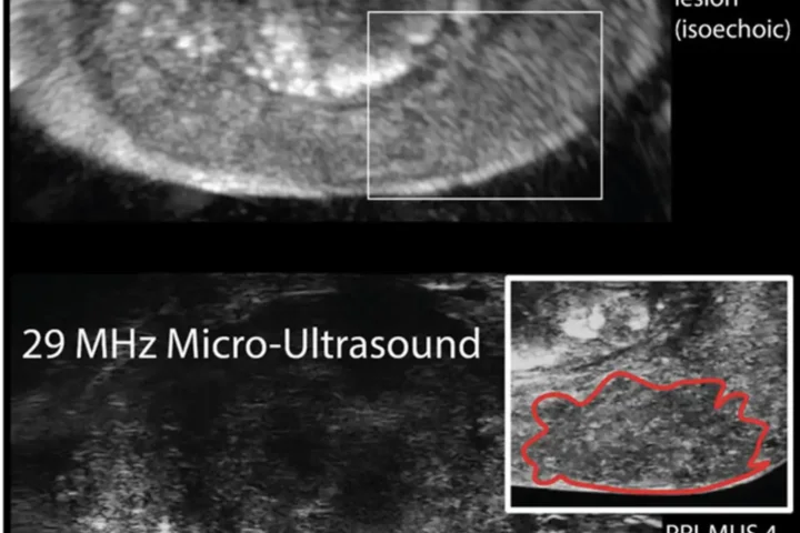 Ultrasound of prostate (above) depicting no lesion (below) depicting PRIMUS 4 mottled appearance