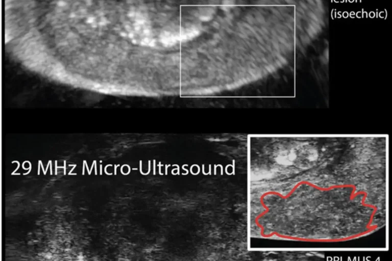 Ultrasound of prostate (above) depicting no lesion (below) depicting PRIMUS 4 mottled appearance