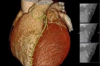 3D image of a heart