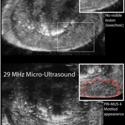 Ultrasound of prostate (above) depicting no lesion (below) depicting PRIMUS 4 mottled appearance